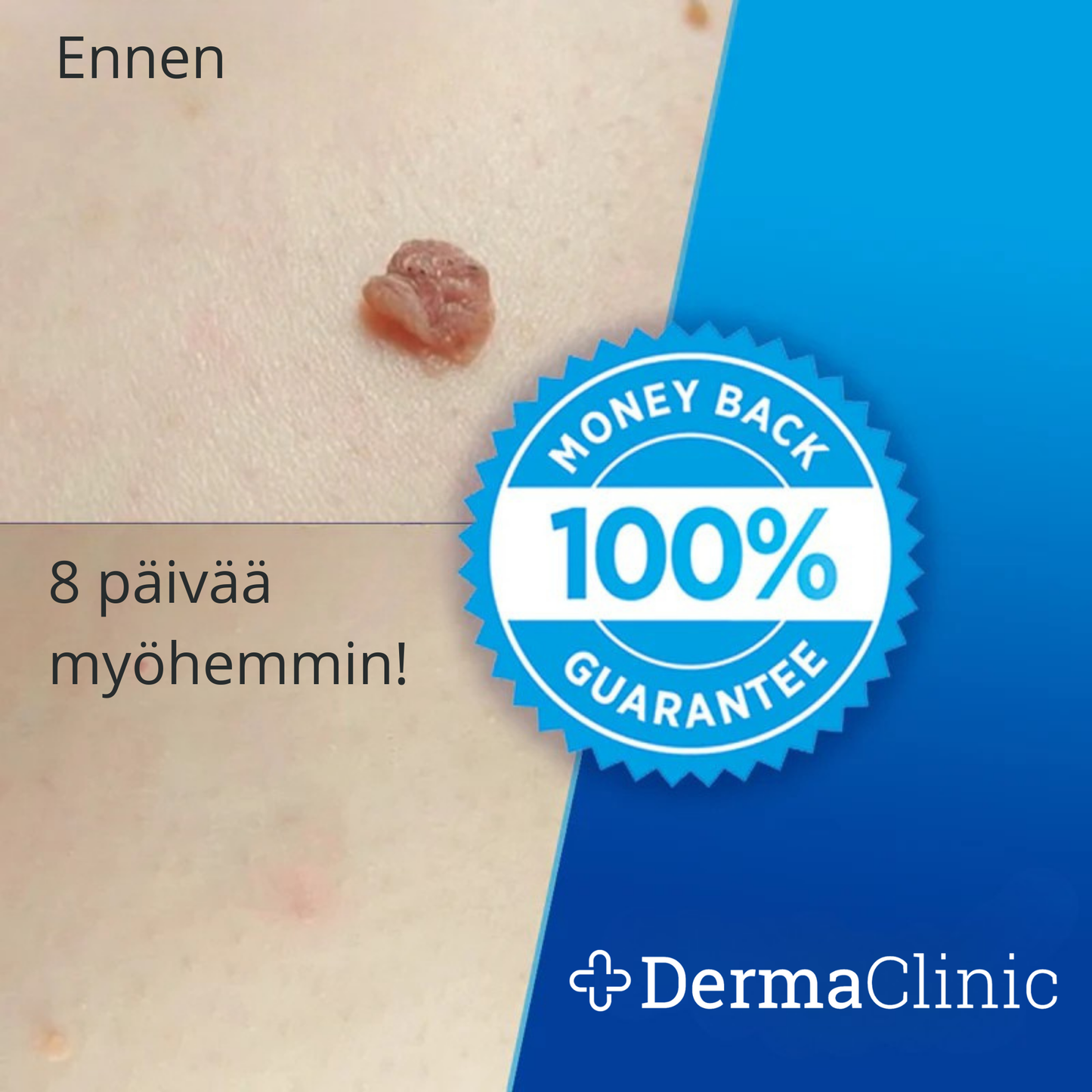 DermaTag™ – Kivuton iholäpän poisto