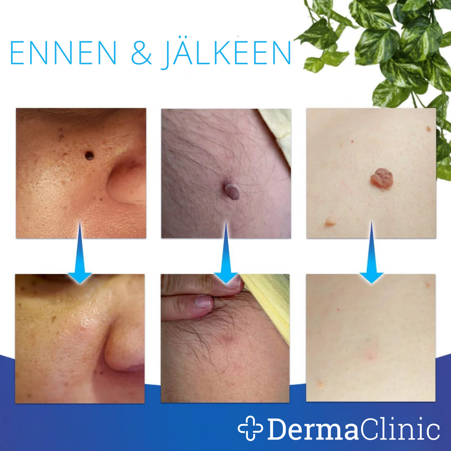DermaTag™ – Kivuton iholäpän poisto